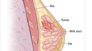  Datopotamab Deruxtecan (DATROWAY) A Paradigm Shift in Metastatic Breast Cancer Treatment 